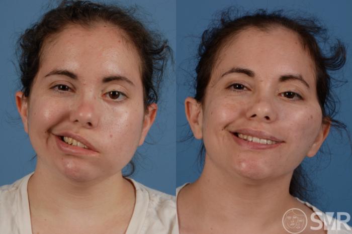 Before and 3 years after a dually innervated free functional gracilis muscle transplant for smile reanimation.