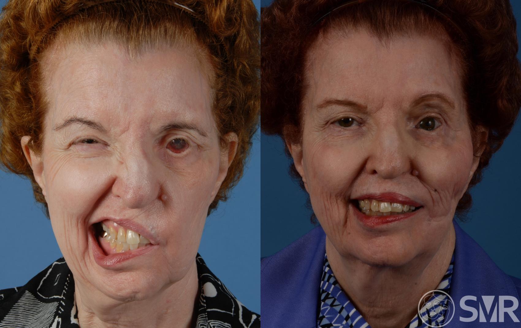 Before and 5 years after a free functional gracilis muscle transplant for smile reanimation.
