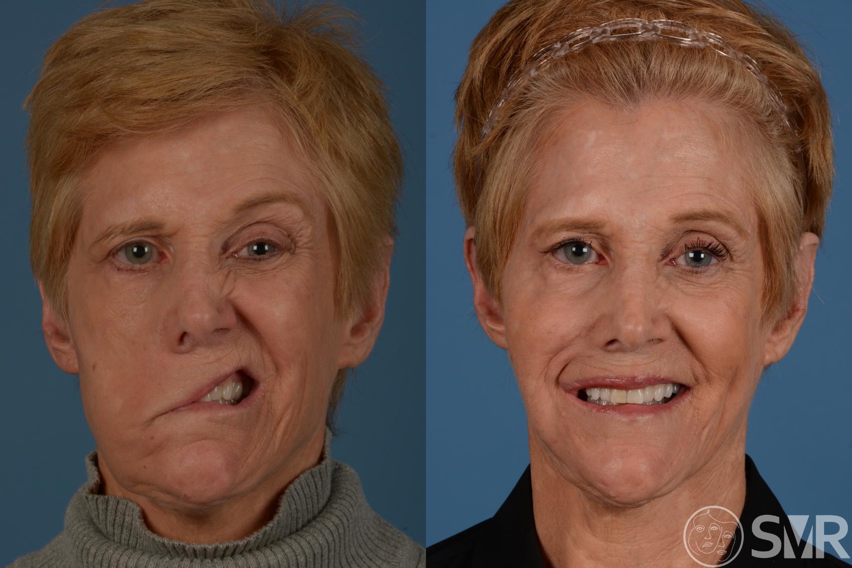 Eyelid Facial Asymmetry Treatments