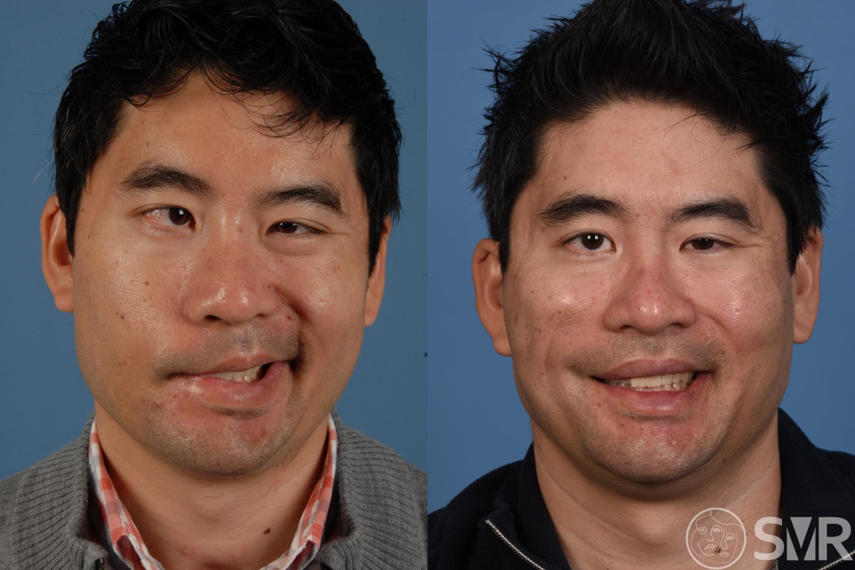 Before and after 6 years after a dually innervated gracilis free muscle transplant for smile reanimation. 