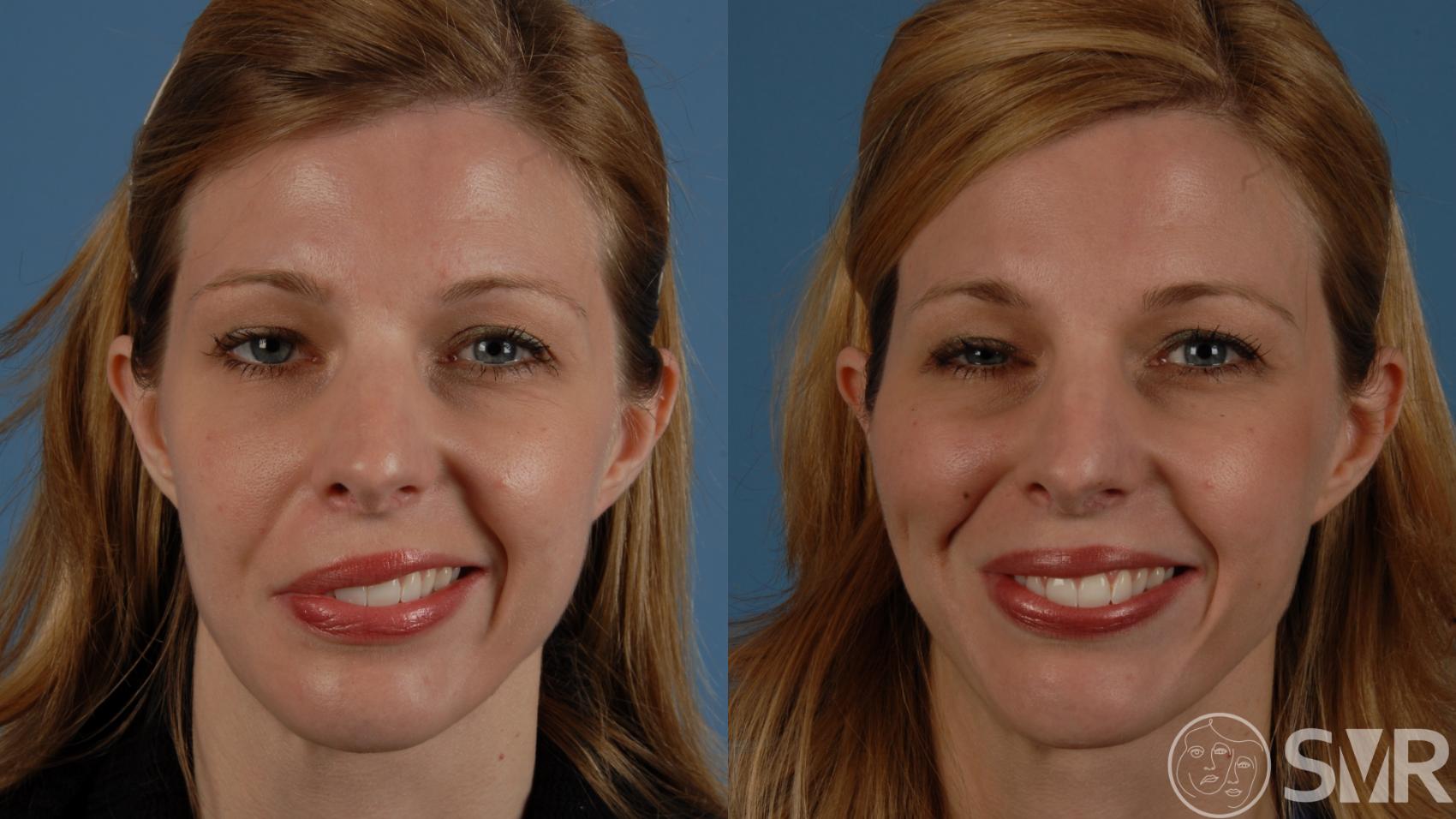 Before and 3 years after a free functional gracilis muscle transplant for smile reanimation.