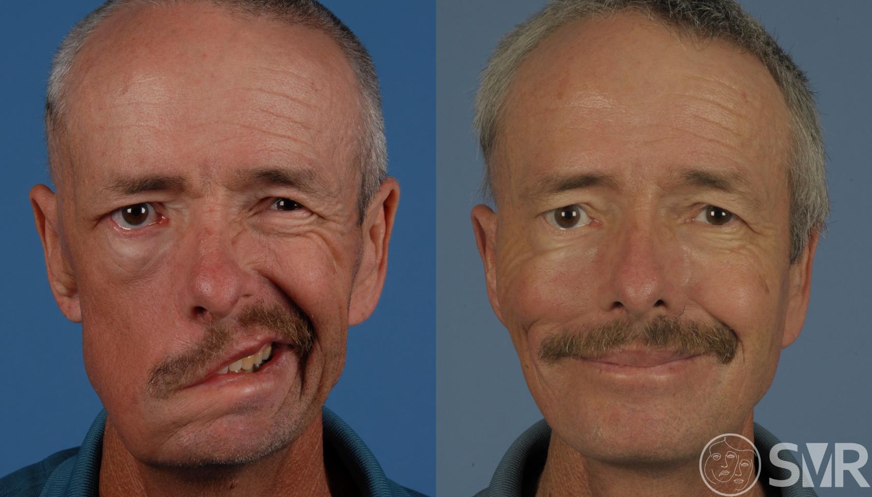 Free Functional Muscle Flap for Smile Restoration Before and After Pictures  Case 9 | Dallas, TX | Shai M. Rozen, ., .S.