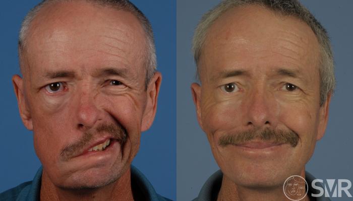 Before and 3 years after a free functional gracilis muscle transplant for smile reanimation.