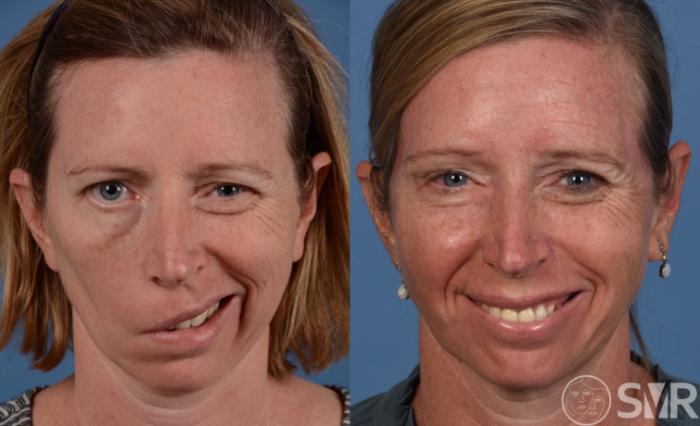 Before and 18 months after nerve transfers and cross facial nerve grafts for smile and eye reanimation.