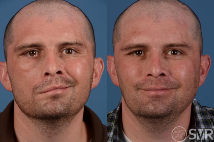 Before and 1 year after nerve transfers, cross facial nerve grafts for smile and eye reanimation.