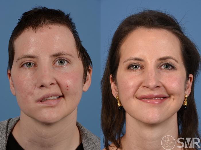 Before and 3 years after nerve transfers, cross facial nerve grafts for smile and eye reanimation.
