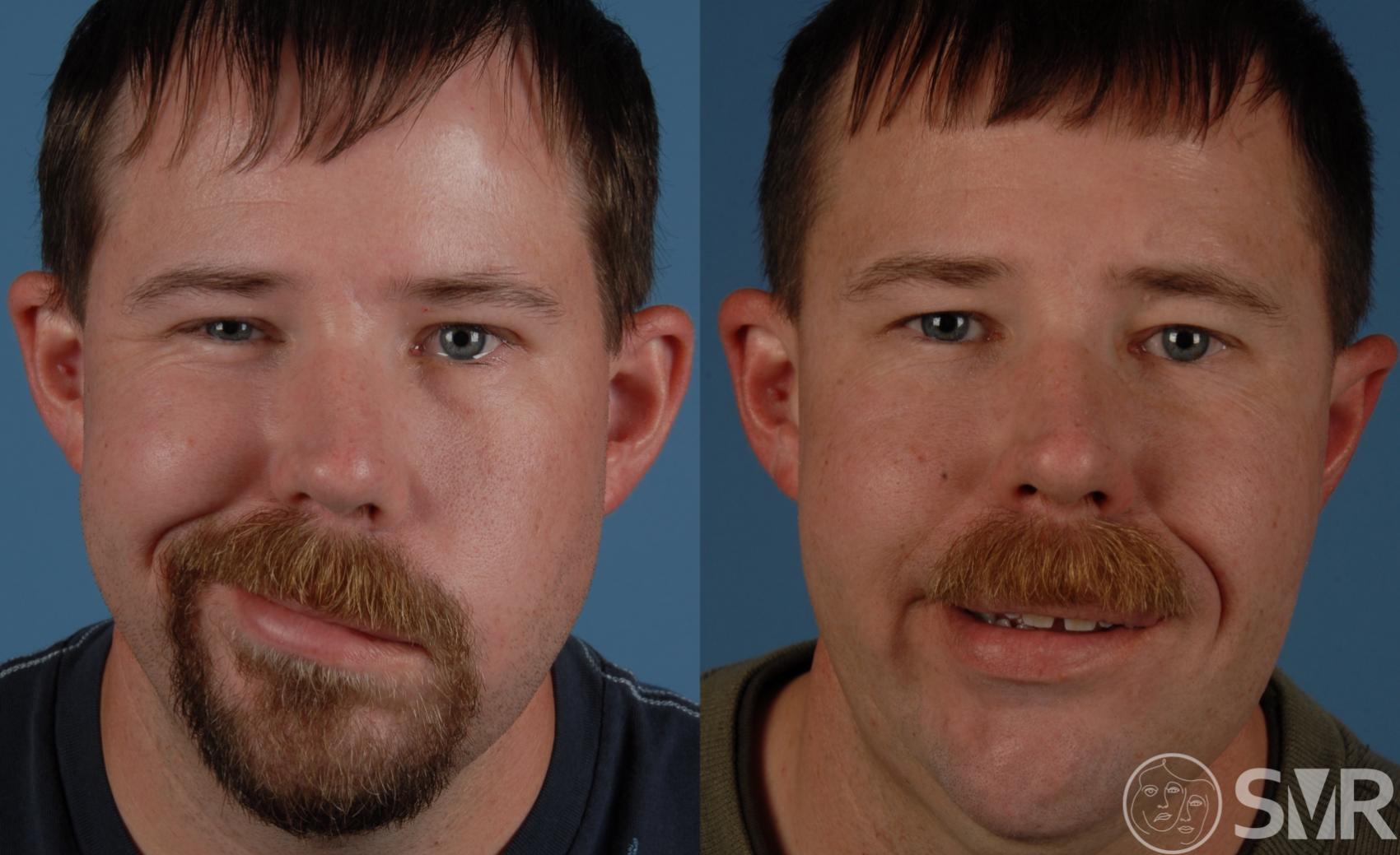 Before and 16 months after nerve transfers and cross facial nerve grafts for smile and eye reanimation.