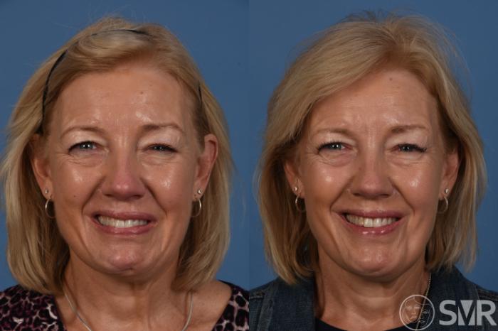 Before and after selective myectomy of the lower lip