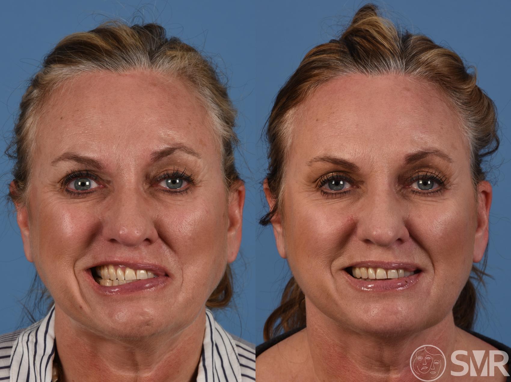 Drooping Face: How to Treat Bell's Palsy with Physiotherapy - pt