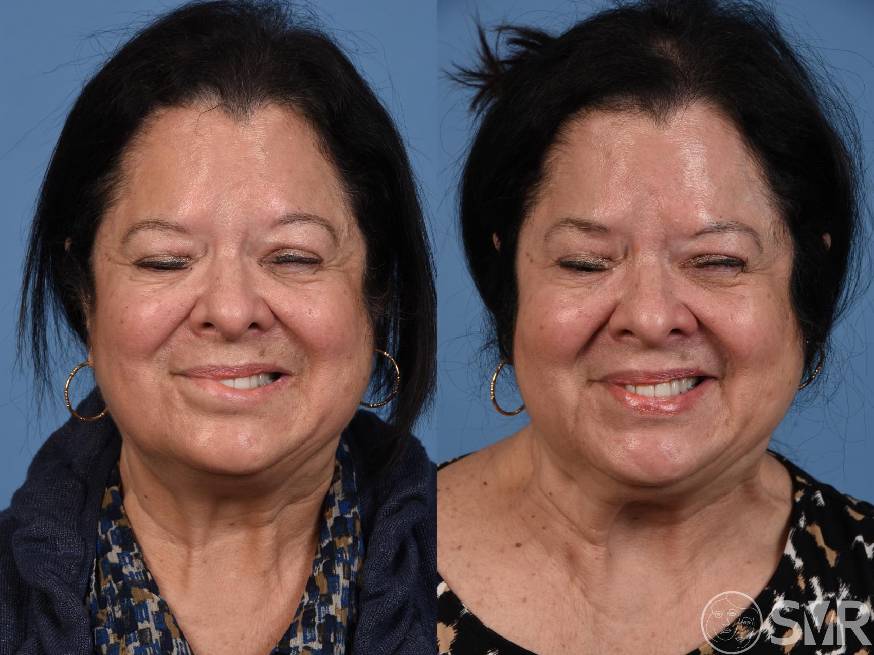 Before and after lower lip myectomy combined later with selective neurectomies.